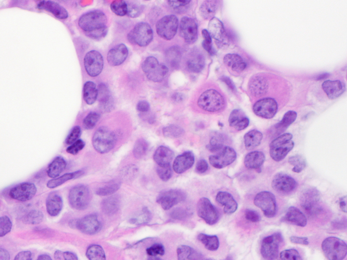 Bone Marrow Biopsy 600x Hypolobate Micromegakaryoctes